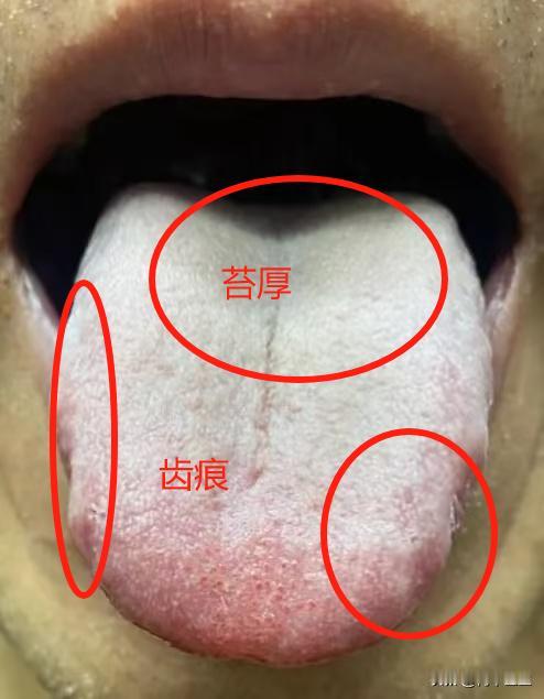 最害怕的舌象就是这样的白厚苔，像是一层打不开的塑料布，什么补药都进不去
为什么会