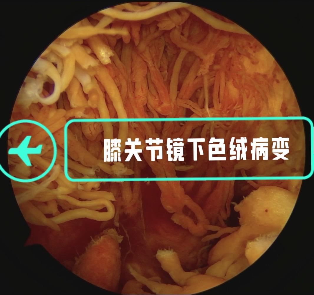 色素沉着绒毛结节性滑膜炎。膝关节反复肿，弥漫型色绒，（PVNS）