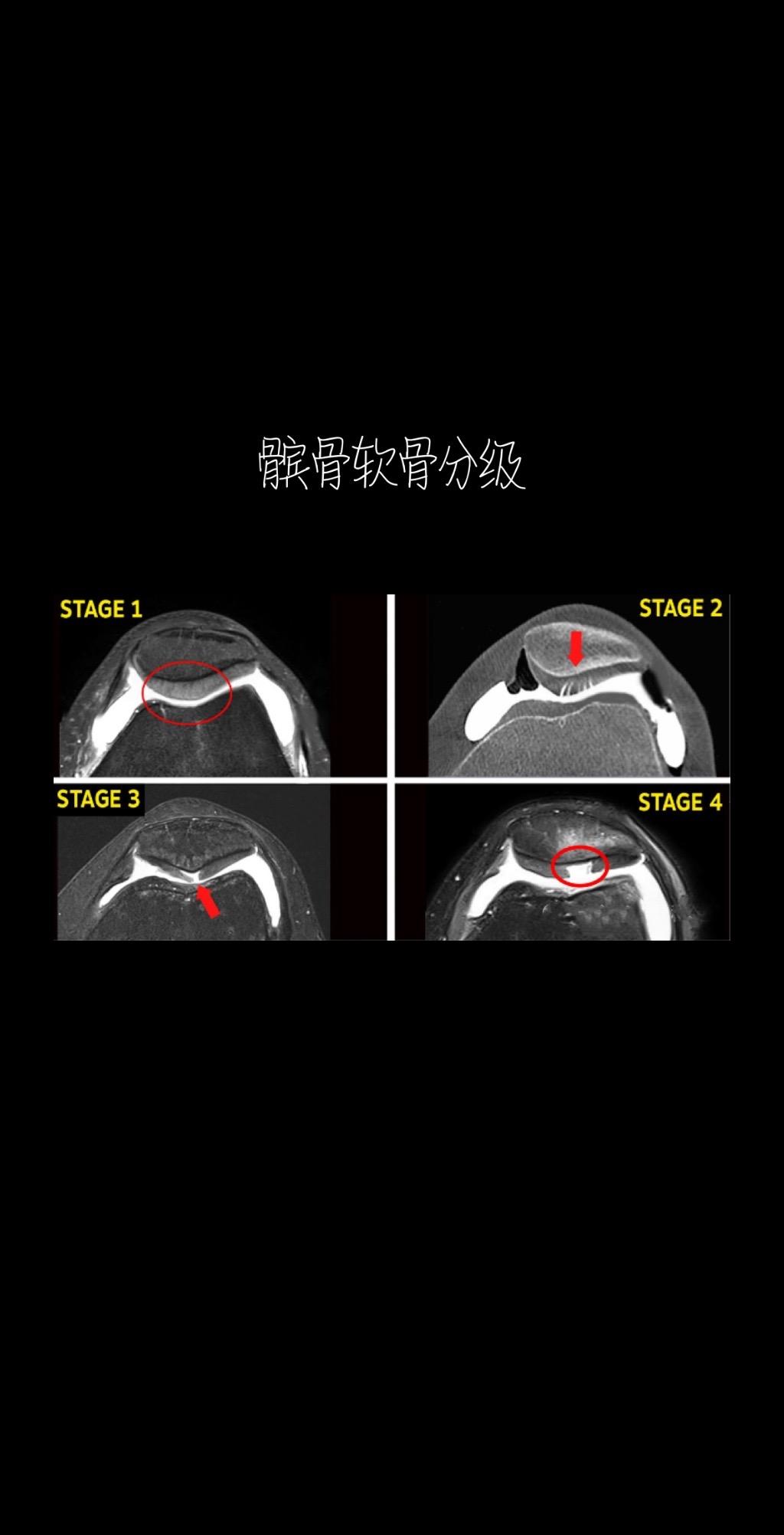 髌骨软骨核磁分级。髌骨软骨的核磁表现