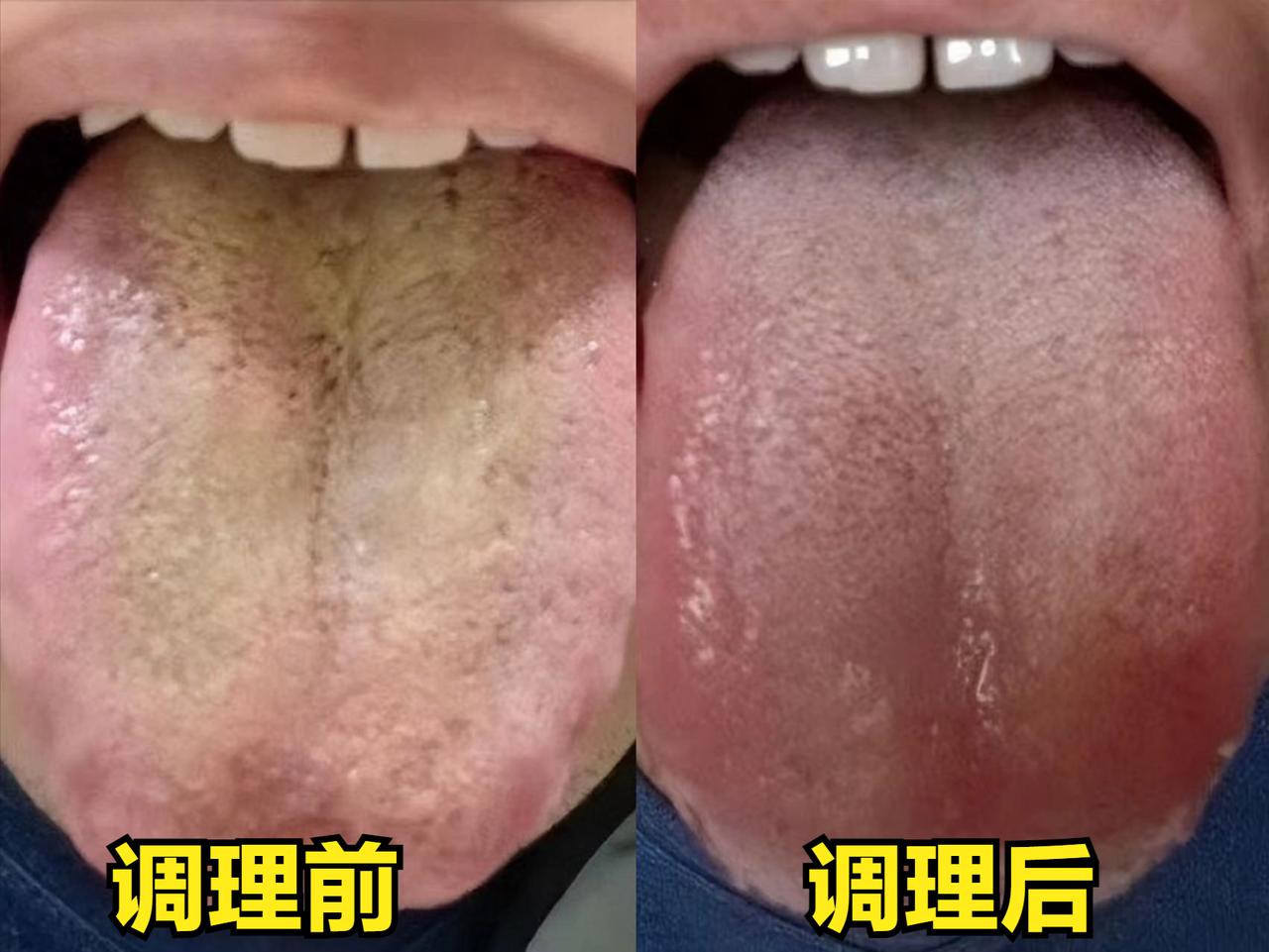 看到黄苔就是有热，就要赶快清热？这种错误思想真是害了太多人！

很多人朋友总是觉
