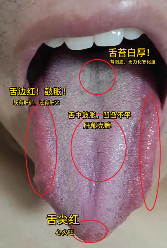 明明就是肝郁，为什么用疏肝的逍遥丸，就是不管用！原因就在舌头上！！



李主任