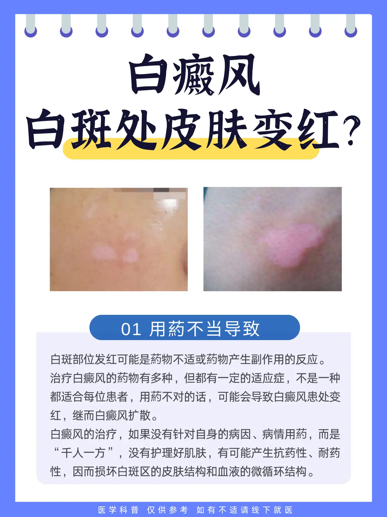 医学科普 白癜风 白斑 皮肤健康 硬核健康科普行动