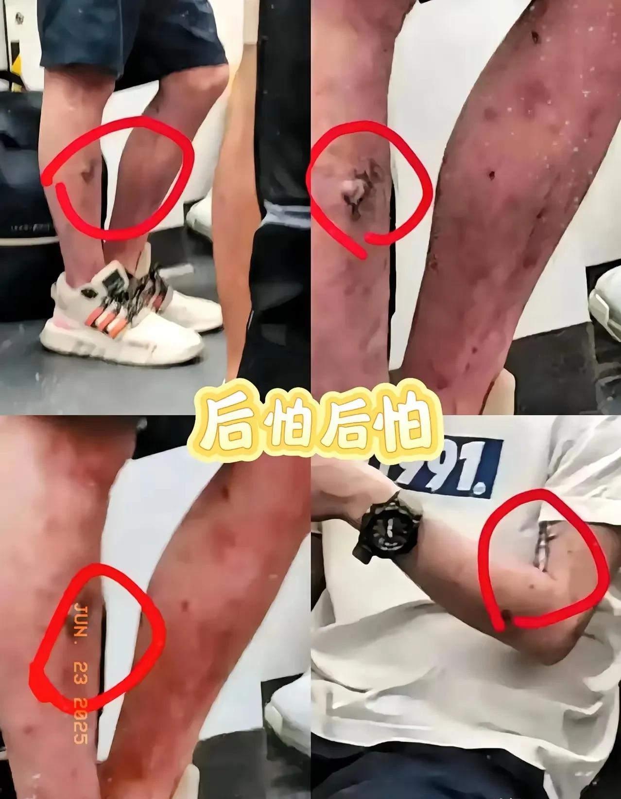 可怕，艾滋病人明目张胆地坐地铁。
有点缺德，地铁人多，挤來挤去，明知有艾滋病应该
