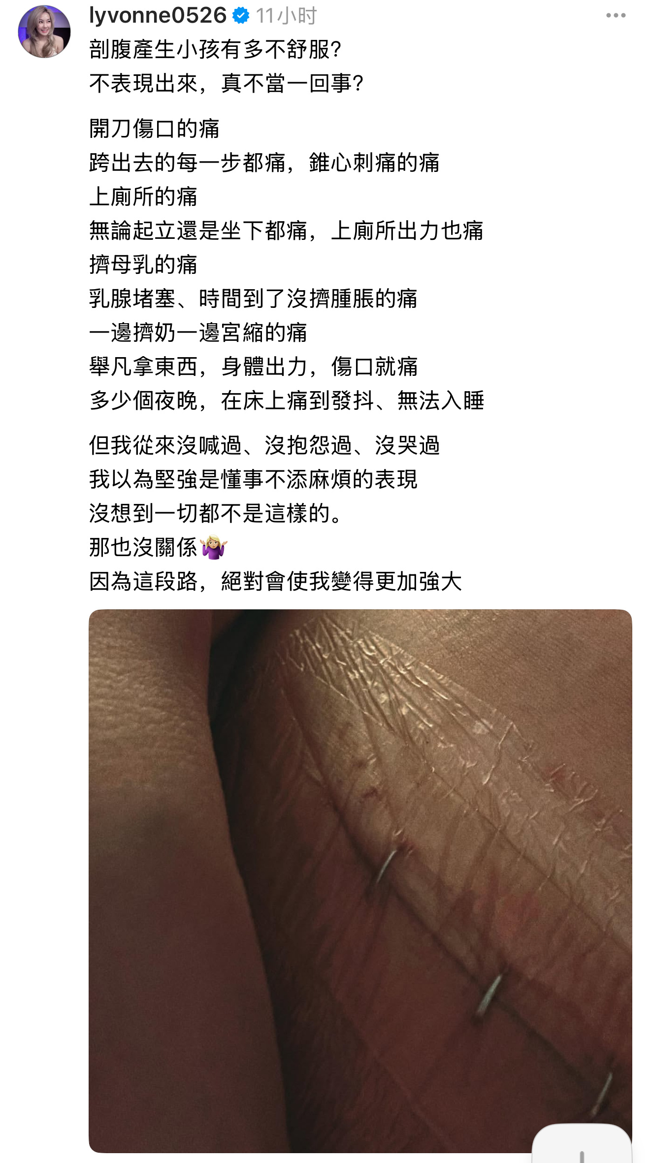 刘雨柔po自己剖腹产伤口照片[衰]剖宫产生孩子有多不舒服？不表现出来，真不当一回