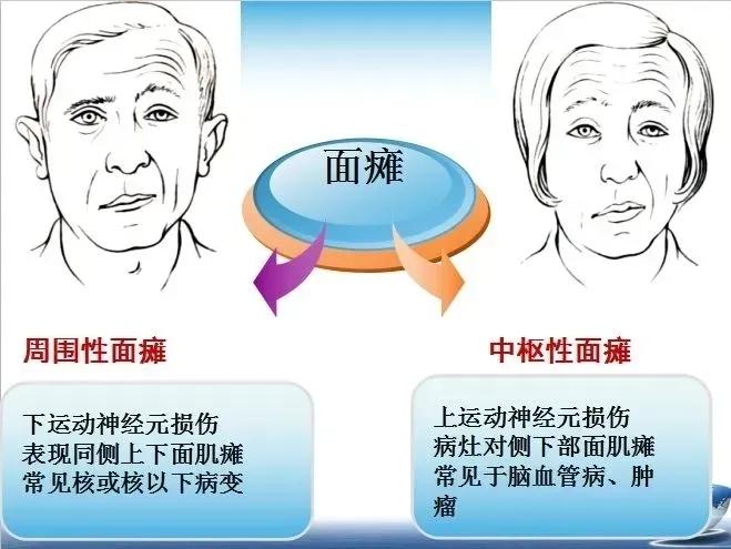 你还在为面神经麻痹困扰吗？今天给大家揭秘老中医家传300余年的面神经麻痹方，轻松