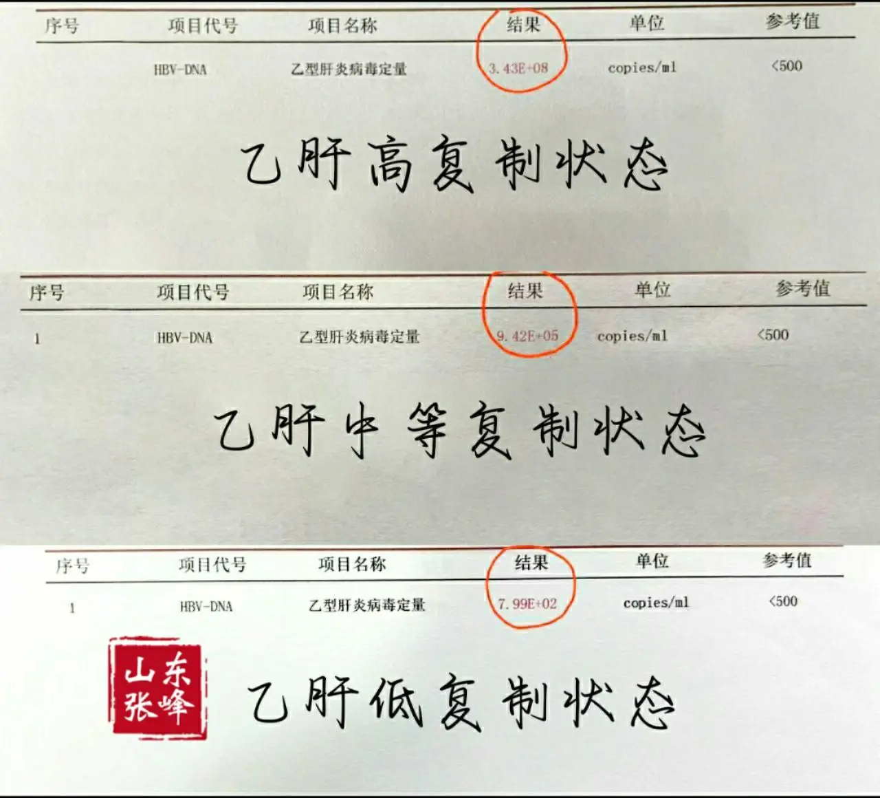 乙肝病毒量高低怎么看？乙肝病毒量的浓度越高，说明体内病毒复制越活跃，传...