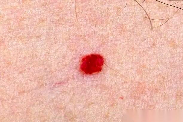 就晒了会儿太阳，胳膊上、脖子上就起了一片小红包，又痒又肿。
你以为是过敏？
想简