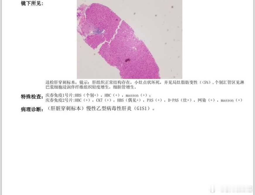 #乙肝[超话]#慢乙肝的病理大部分都会有点状坏死 ​​​