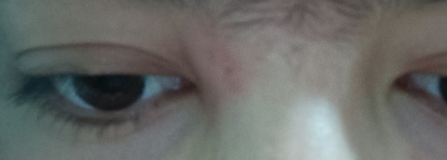 不是我服了啊啊啊😭突然怎么就肿了呢？早上我起来的时候不是只有昨天长的痘痘吗？怎