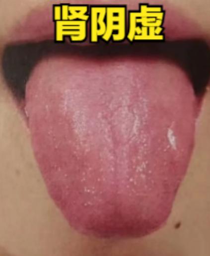 补肾就记一句话：红舌不补阳，白舌不滋阴

1.红舌不补阳
红舌是肾水不足，虚火内