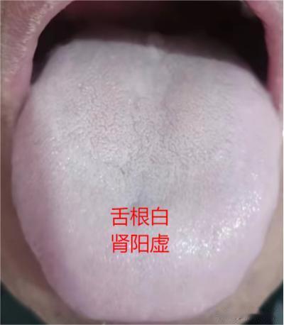 舌根白用桂附，舌根裂纹用五子，舌根红用六味
舌根白用桂附
舌象：舌根发白
症状：