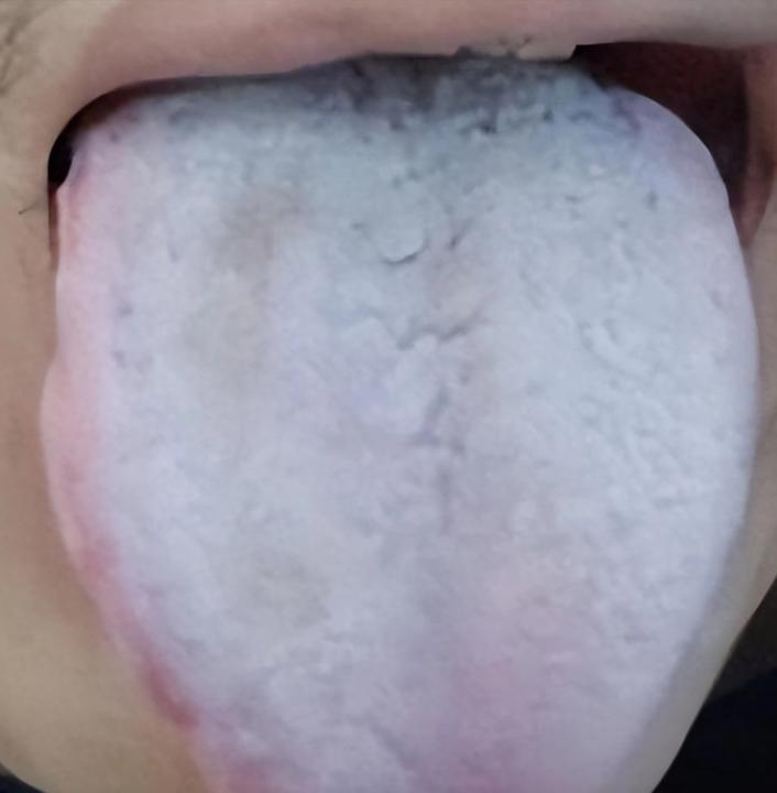 舌头惨白阳虚怕冷？一补就上火？3步调理，温阳不上火！

很多人都有这样的困扰：阳