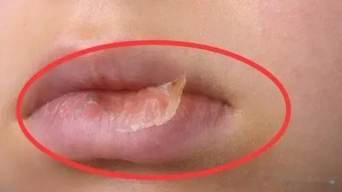 【家长求助】：孩子嘴巴干燥起皮，使劲喝水也不管用，这是怎么回事？

孩子正常嘴唇
