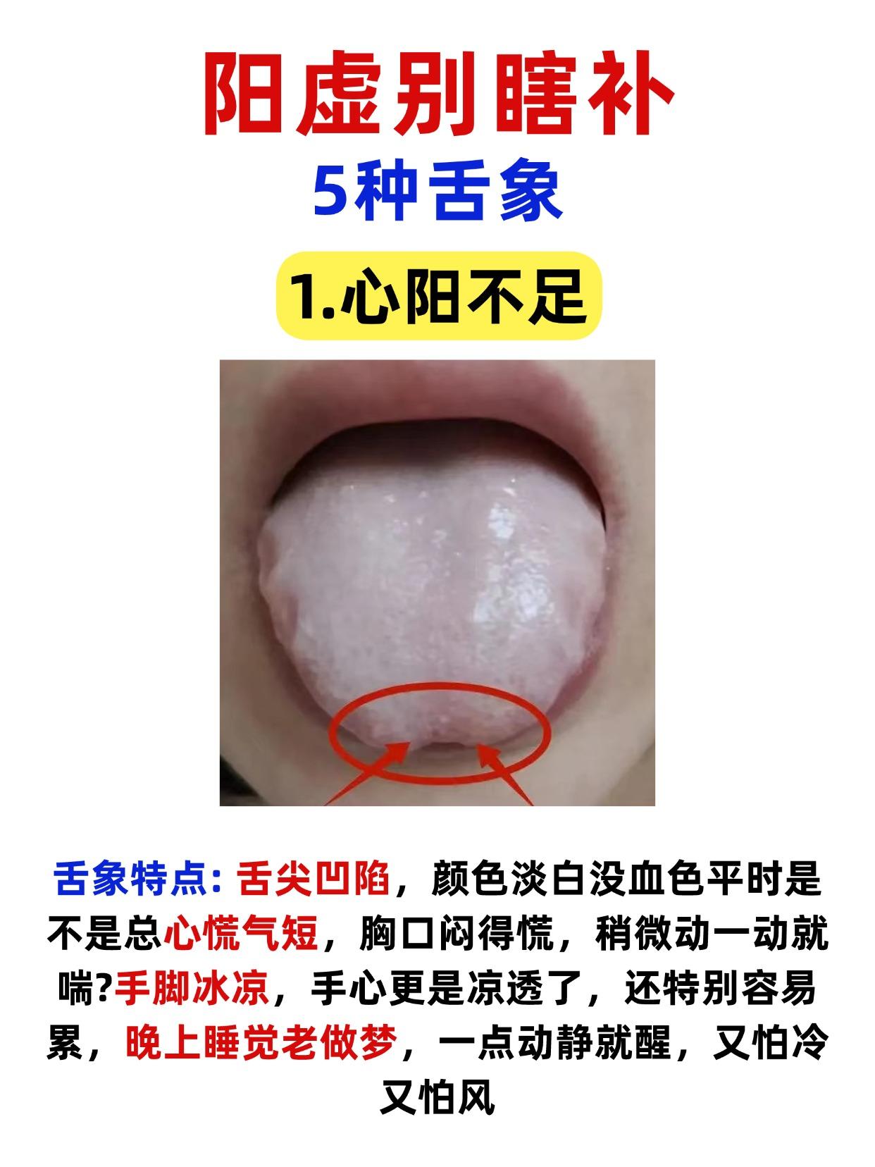 阳虚别瞎补！5 种舌象对照，一看就懂！

1.心阳不足
舌象特点: 舌尖凹陷，颜