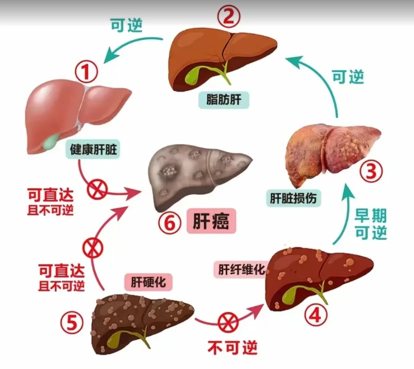 脂肪肝没事吗？看看它的发展进程！