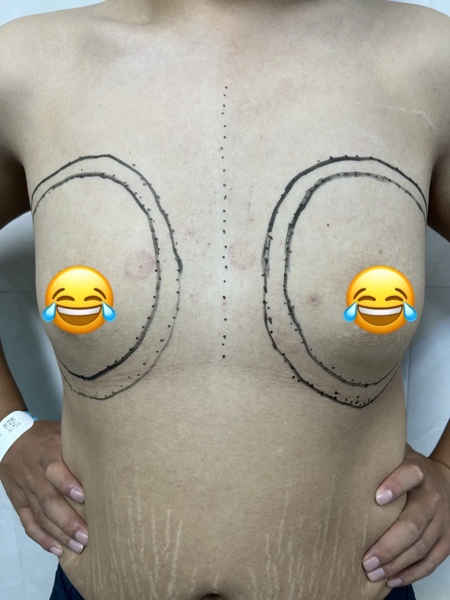 腔镜下男性乳腺发育症案例分享。随着现在微创技术的发展，腔镜技术的成熟...