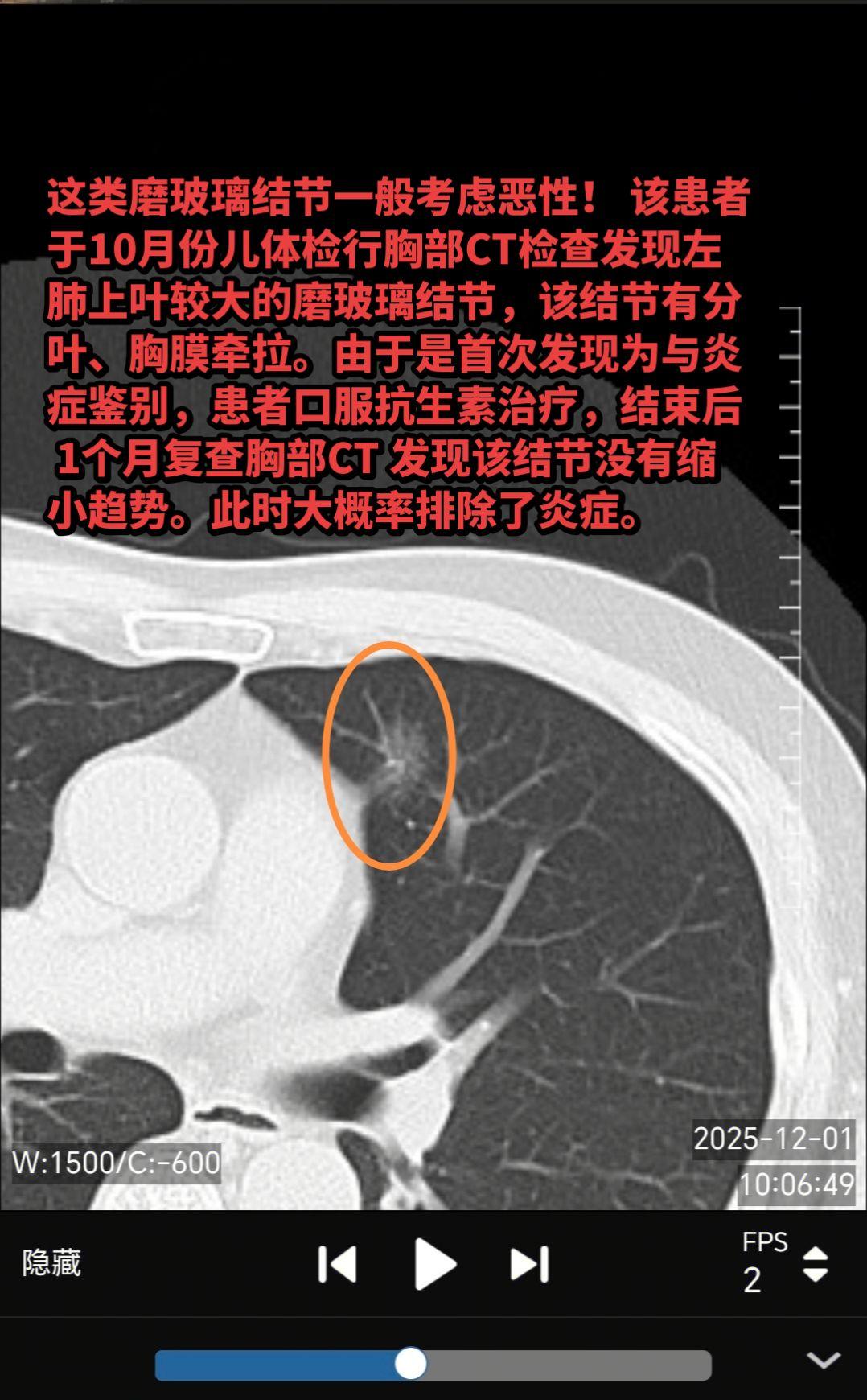 这类磨玻璃结节多考虑是肿瘤性的！该患者于10月份儿体检行胸部CT检查发...