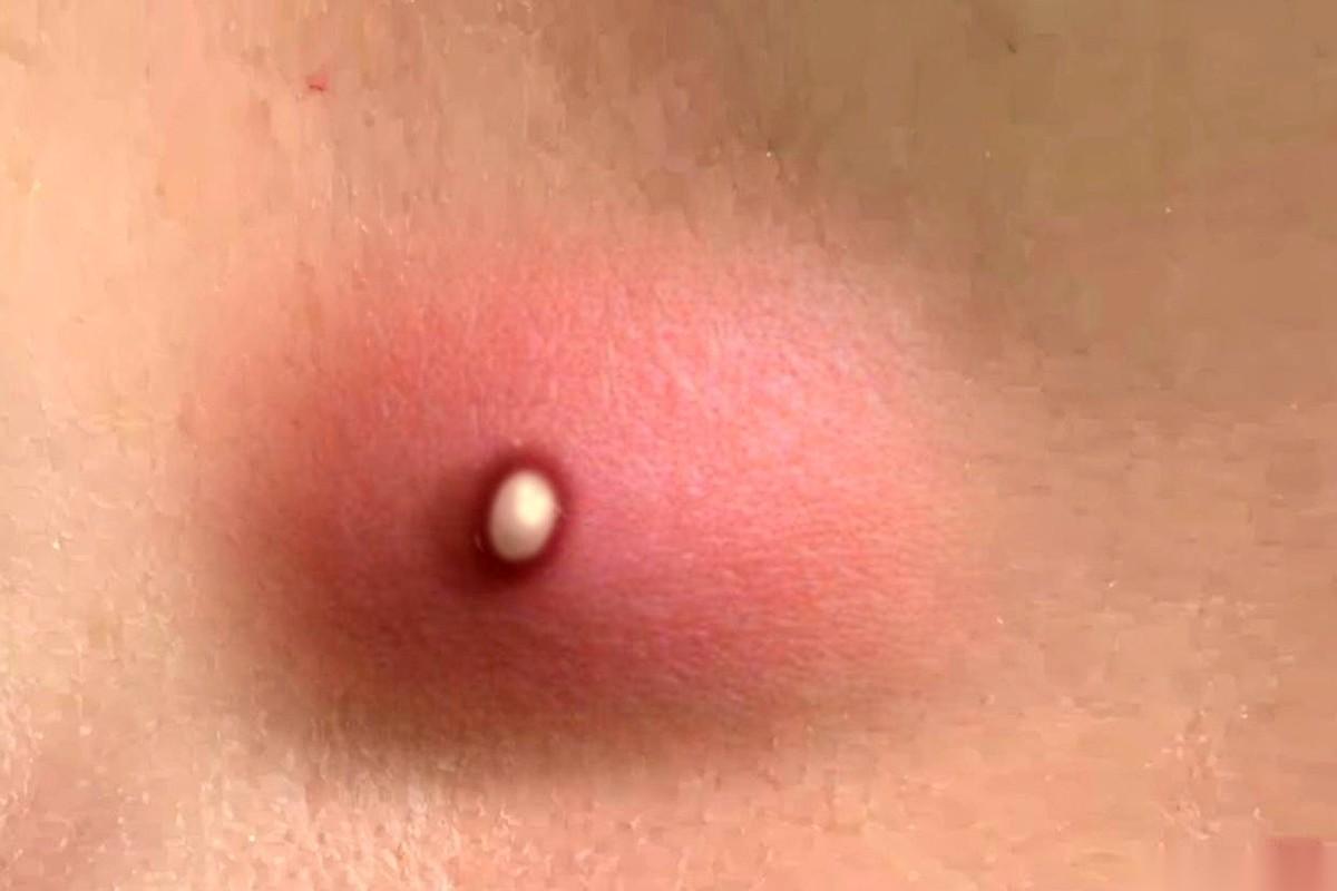 走路姿势都变形了，大腿根那个地方，肿得跟个鹌鹑蛋似的，又红又烫，碰一下，感觉像有