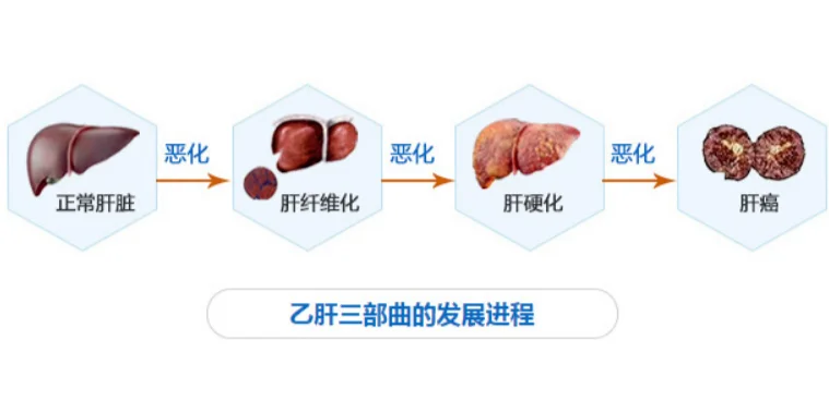很多患者查出肝硬化之后，都会很害怕，充满警惕。前天老洪我就接诊了一个山...