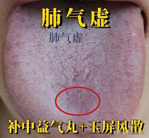 补中益气丸巧搭配，除了补中益气，还能治这几种病
第一：补中益气丸+玉屏风散
适用