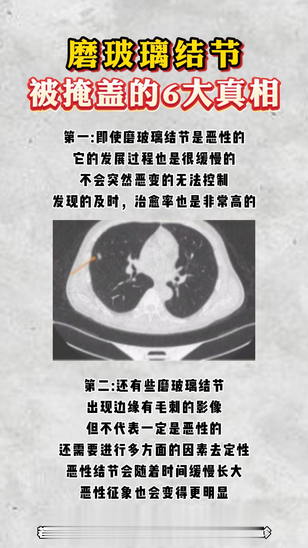 磨玻璃结节被掩盖的6大真相。