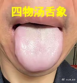 血虚——舌白；血热——舌红；血燥——舌裂纹；舌淤——舌紫；血虚的4种证型​①、血