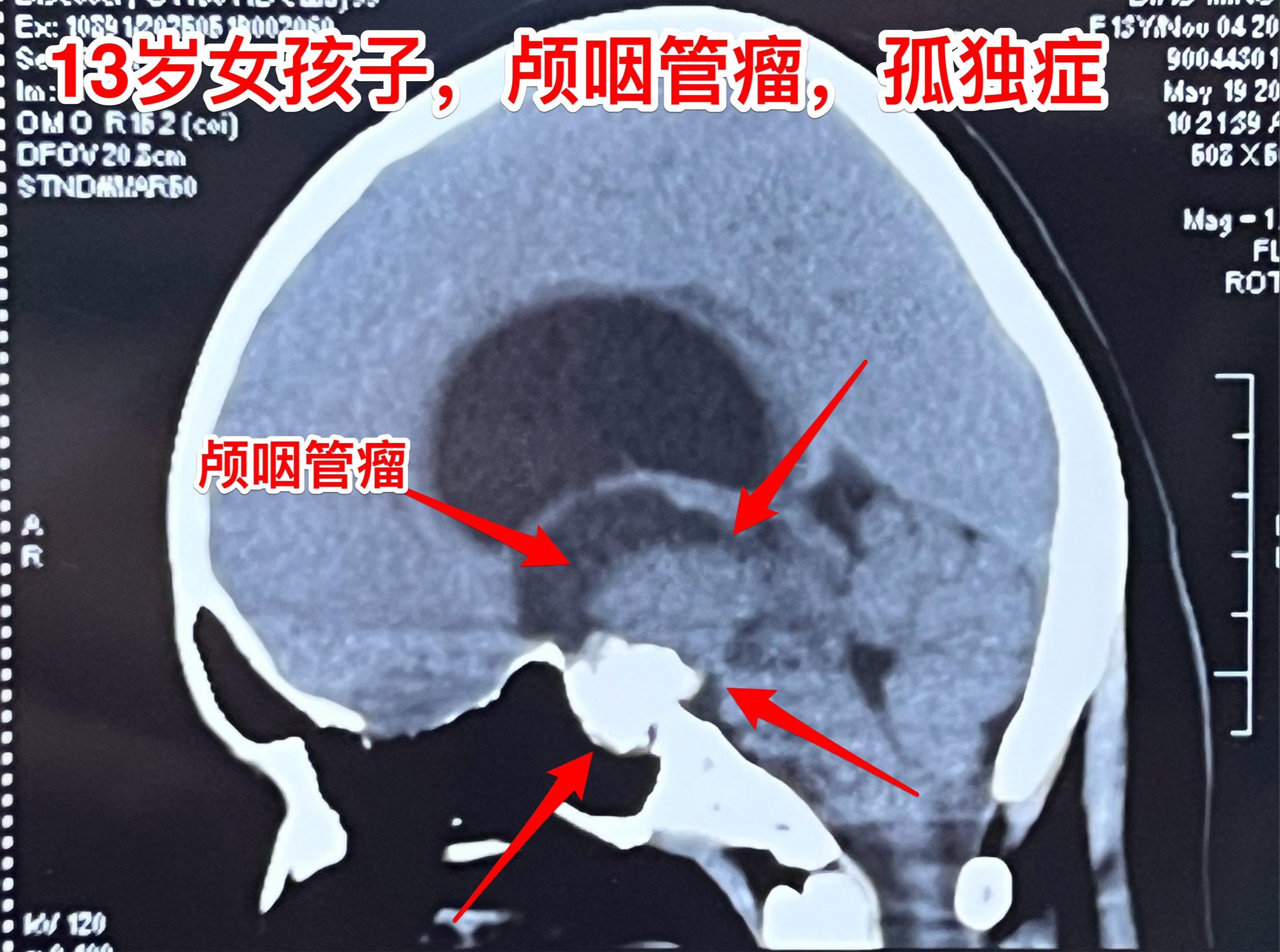 孤独症小孩子5月30日作了颅咽管瘤手术。来自新疆克拉玛依的13女孩子...