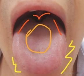 舌诊实战分享：
病人主诉：怕热、手汗多、大便不成形、小便频繁 
舌象分析：
舌质