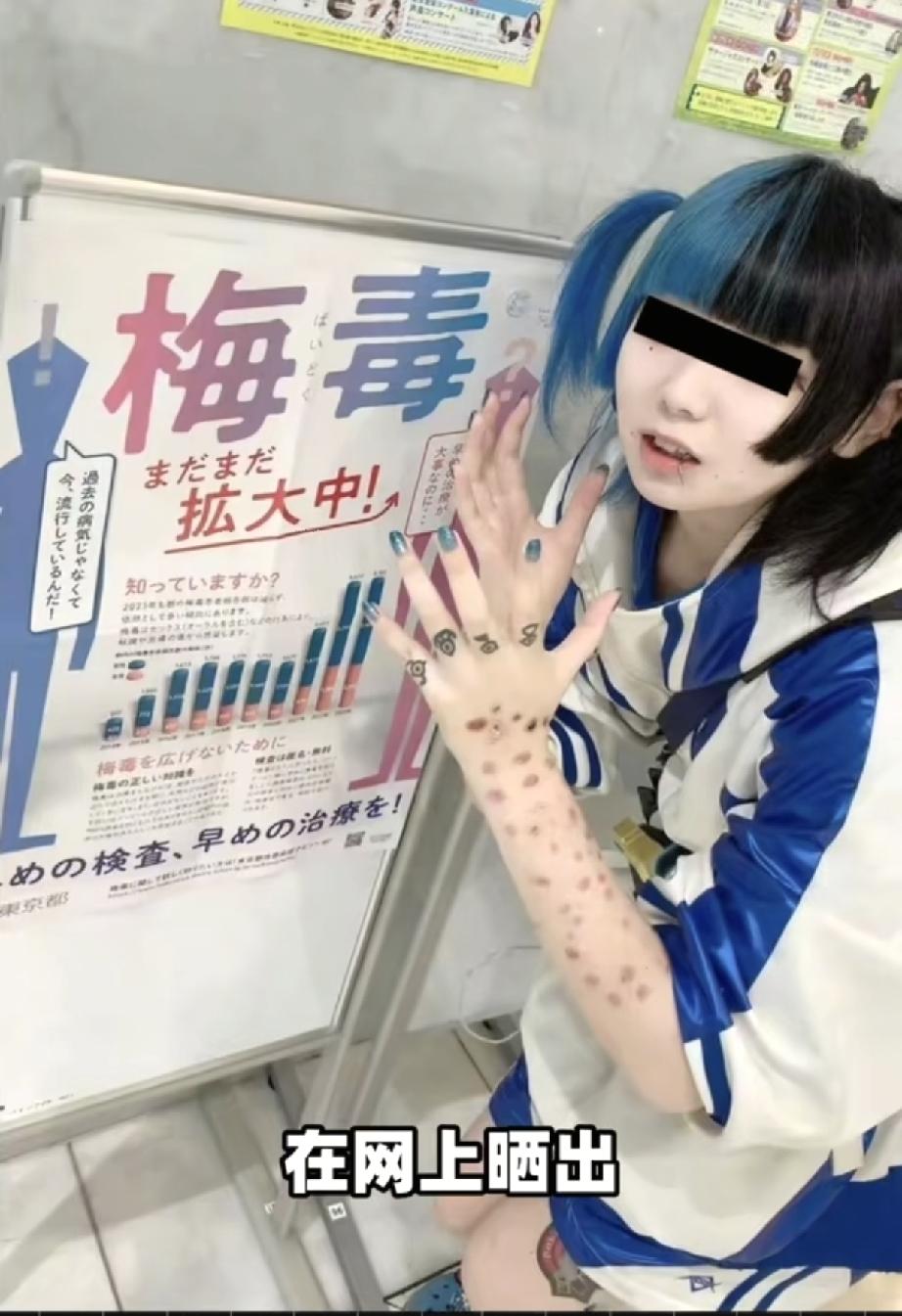 日本梅毒疫情持续走高，十年暴涨十余倍，治疗药物还出现短缺
 
日本的梅毒感染病例