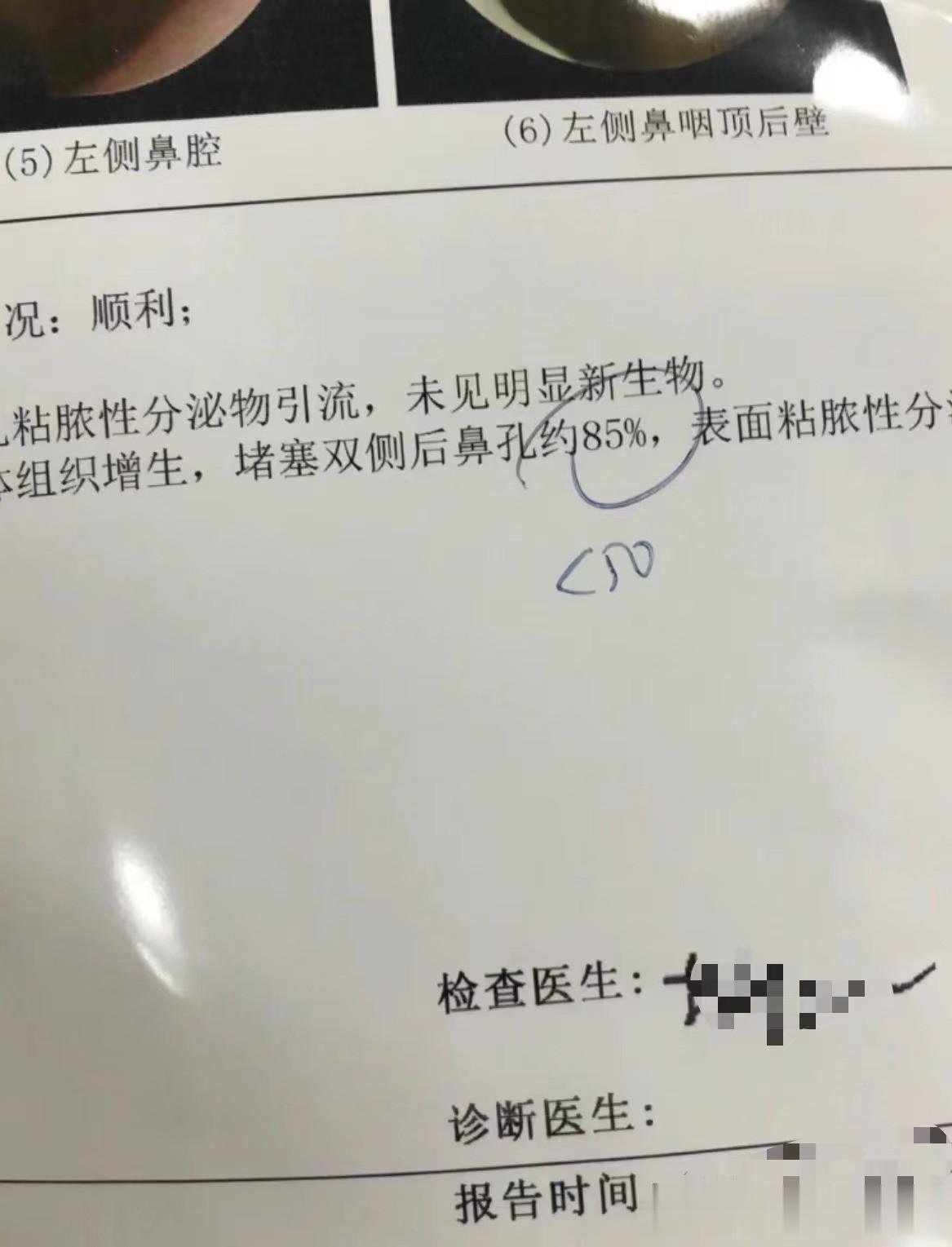 反复感冒、扁桃体发炎，口呼吸，睡觉打呼，检查腺样体堵塞85%！
 
腺样体2-6