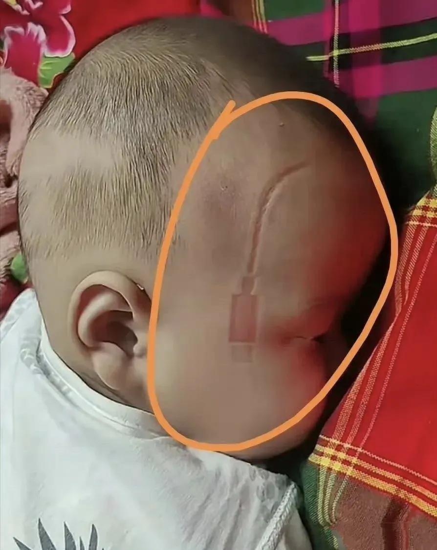 有网友分享了自己家孩子的照片，并说：医生说，如果再多压三四个小时，这个充电器印子
