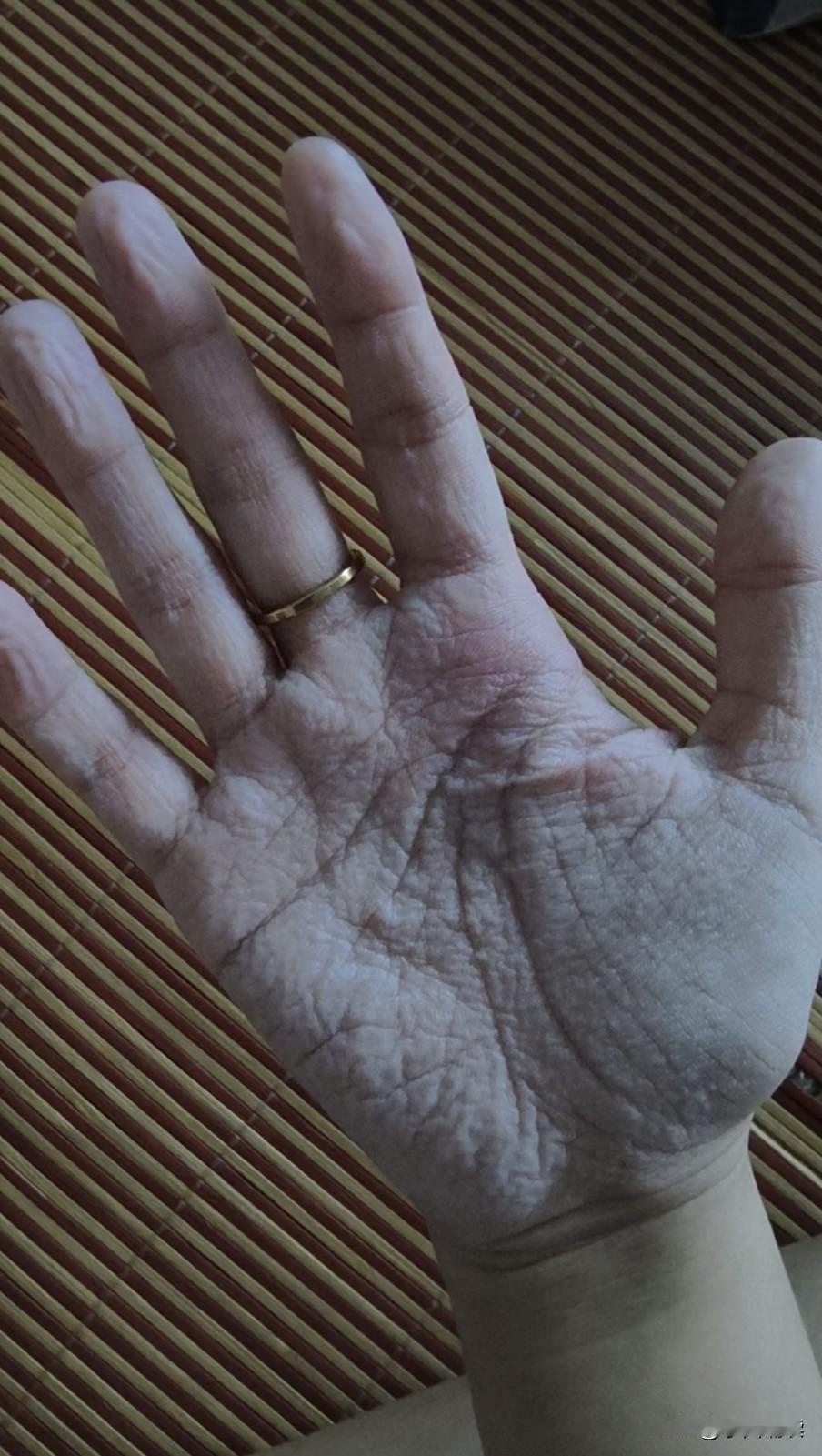 有多少人像我一样，手在水里稍微泡长一点时间就变成这样，是病吗？