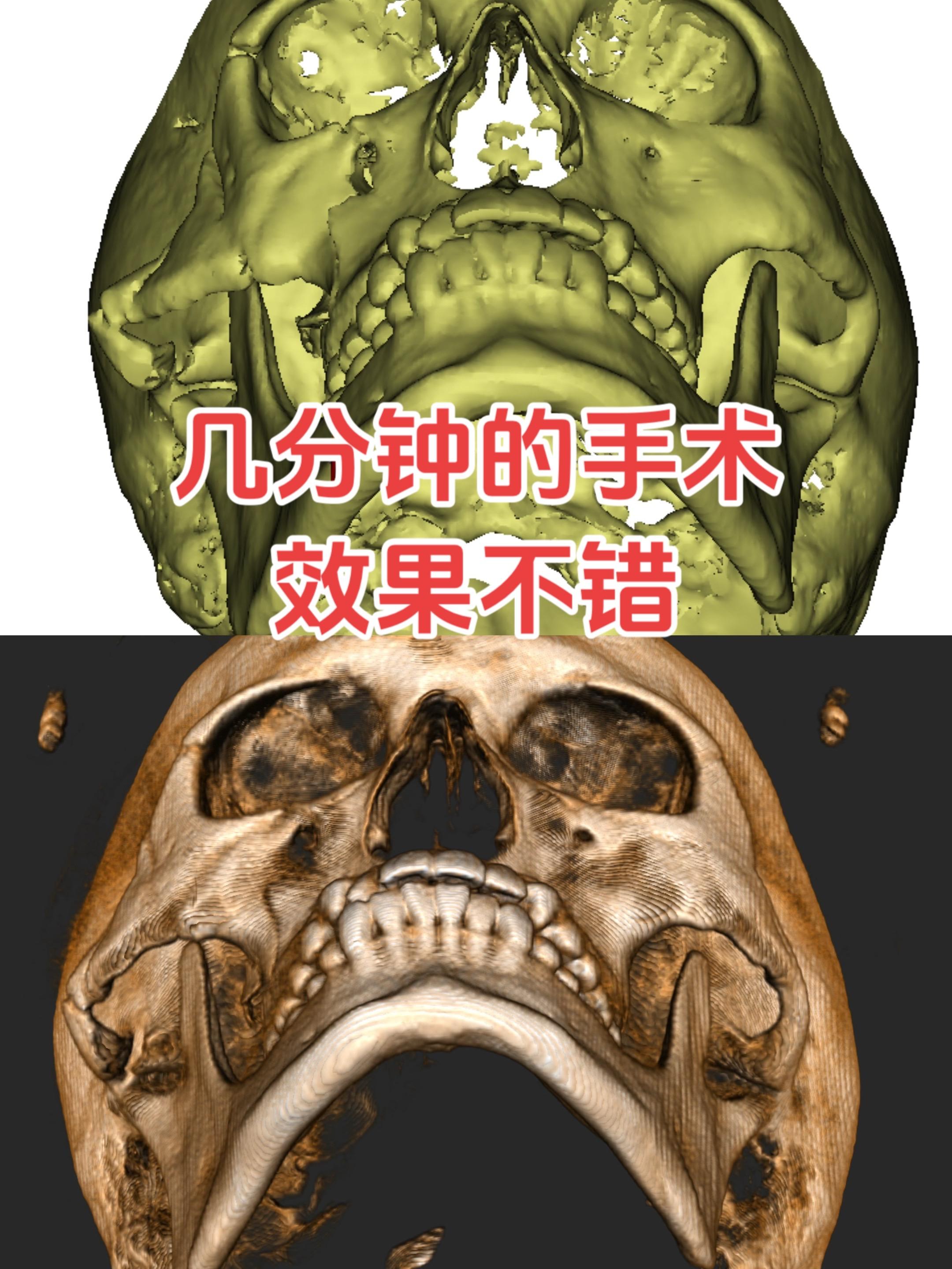 颧骨颧弓骨折撬拨复位术。几分钟搞定，塌陷的面部立马恢复，复查还算满意。