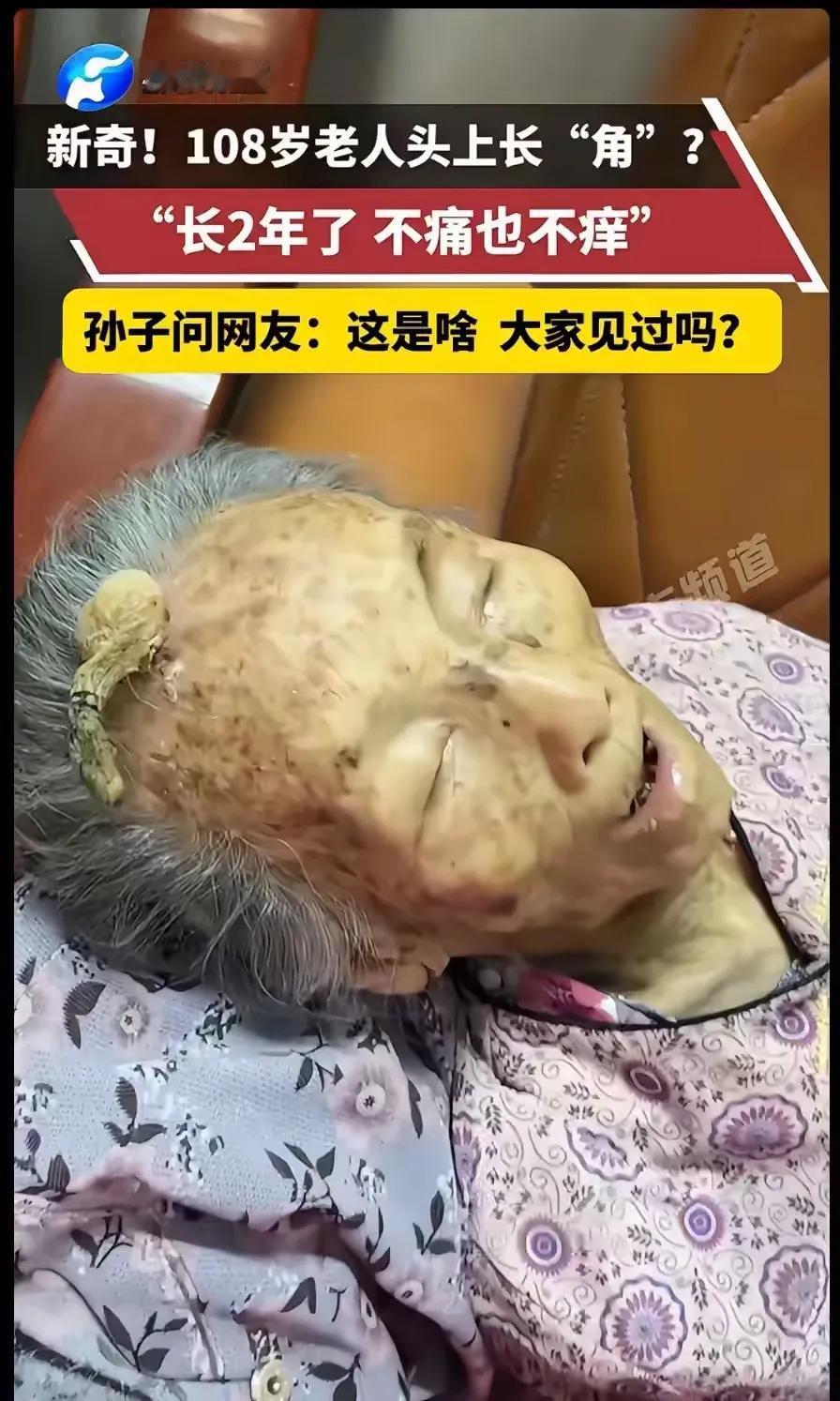 108岁老奶奶的额头上，长出一个这样的东西，据说也不疼也不痒，只是看着有些不太好