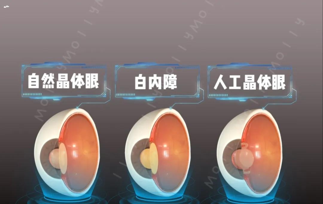 此科普针对大众理解，白内障解决的是光线进入眼睛内，如果仅仅白内障，效果...