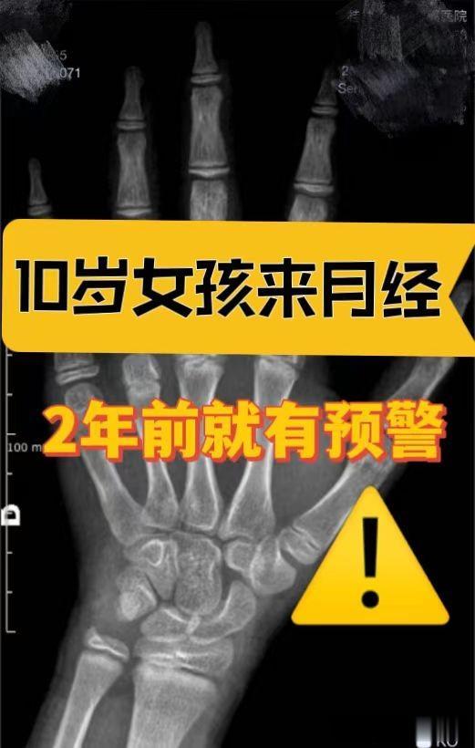 10岁女孩来月经，2年前就有预警了！可惜家长没在意
 
这个姑娘来找我看诊时是因