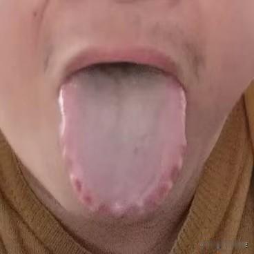 齿痕都这样了，再用普通的祛湿药就像鹅卵击石，得治病根才行

患者主诉：平时特别容