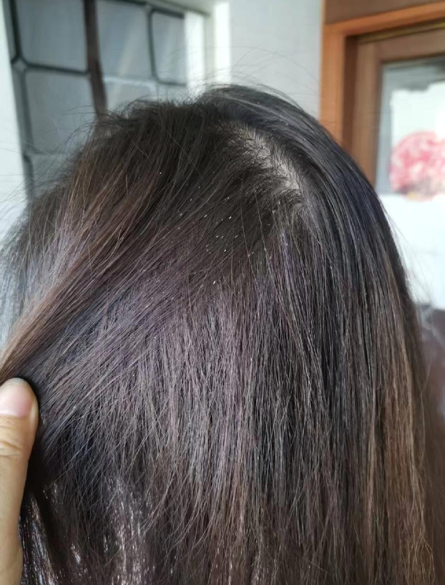 我最近发现头发丝上总有一粒粒小白点，粘在头发上抠都抠不下来，梳头发也梳不掉，看着