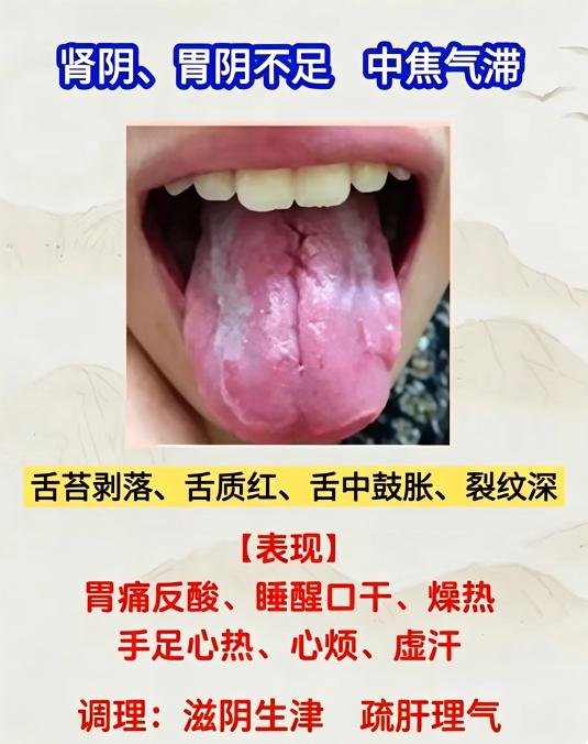 舌头上长裂纹代表什么？4 种裂纹舌，看懂自己体质