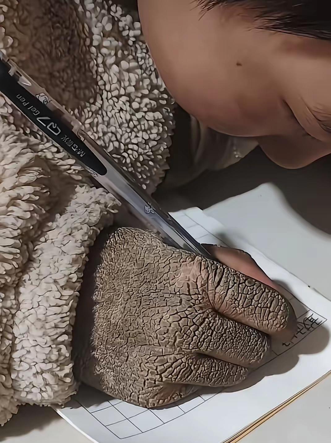 惊讶！有个农村男孩的手竟长满像蛇皮一样的鳞片，又硬又黑，手背上全是疙瘩状凸起，这