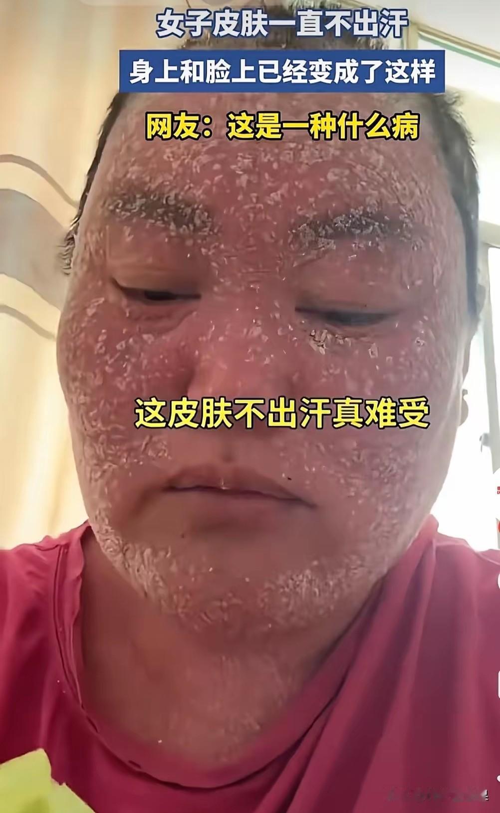 看着真让人揪心！这名女子患上罕见皮肤问题，身体没办法正常出汗，整张脸大面积起皮、