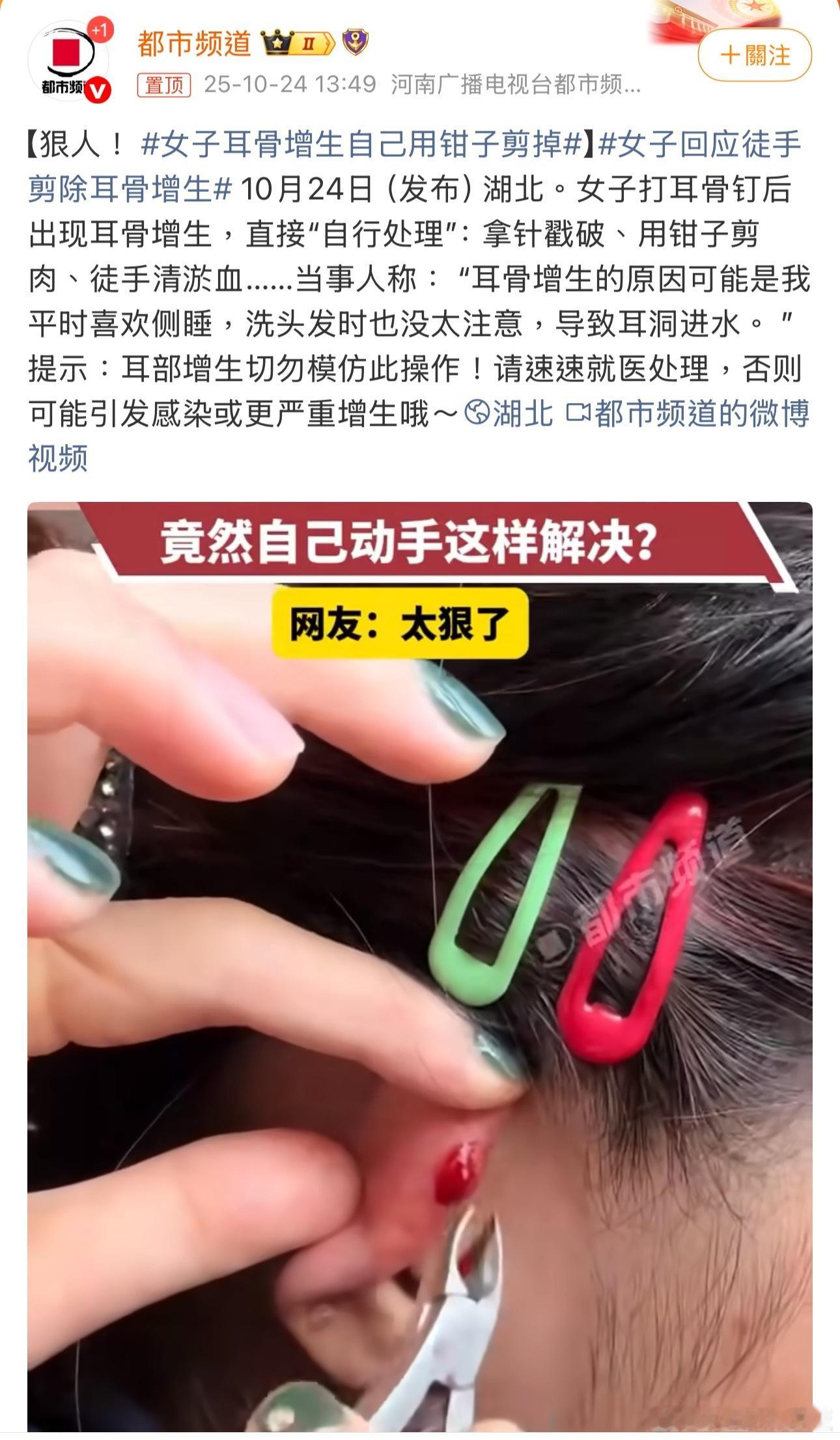 女子耳骨增生自己用钳子剪掉耳骨增生又疼又闹心能懂，但拿钳子硬剪也太吓人！没消毒的
