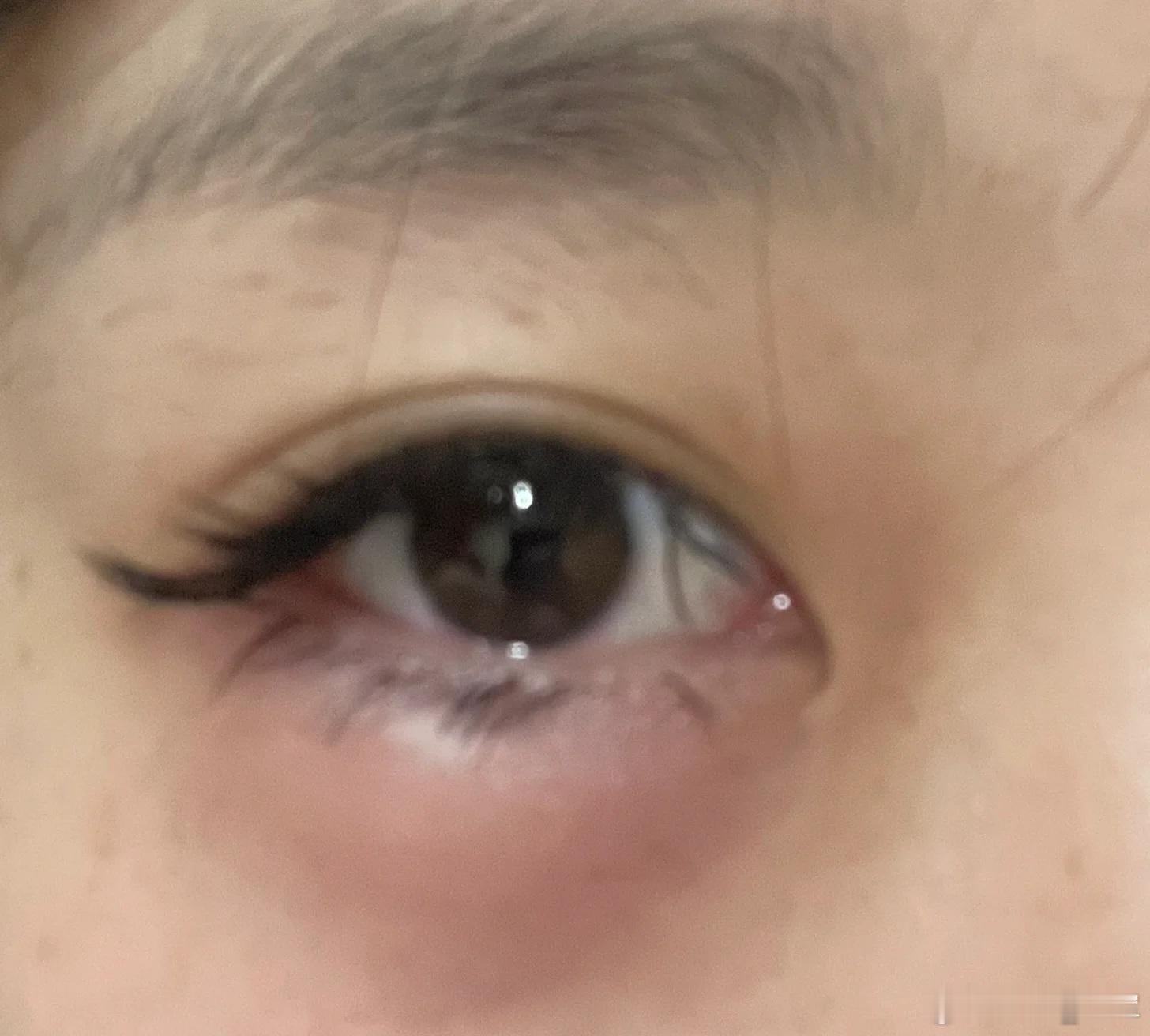 六君子汤：“祛湿消肿方”，专克眼皮肿、脾虚乏力🙋核心本事：健脾祛湿、益气和胃，