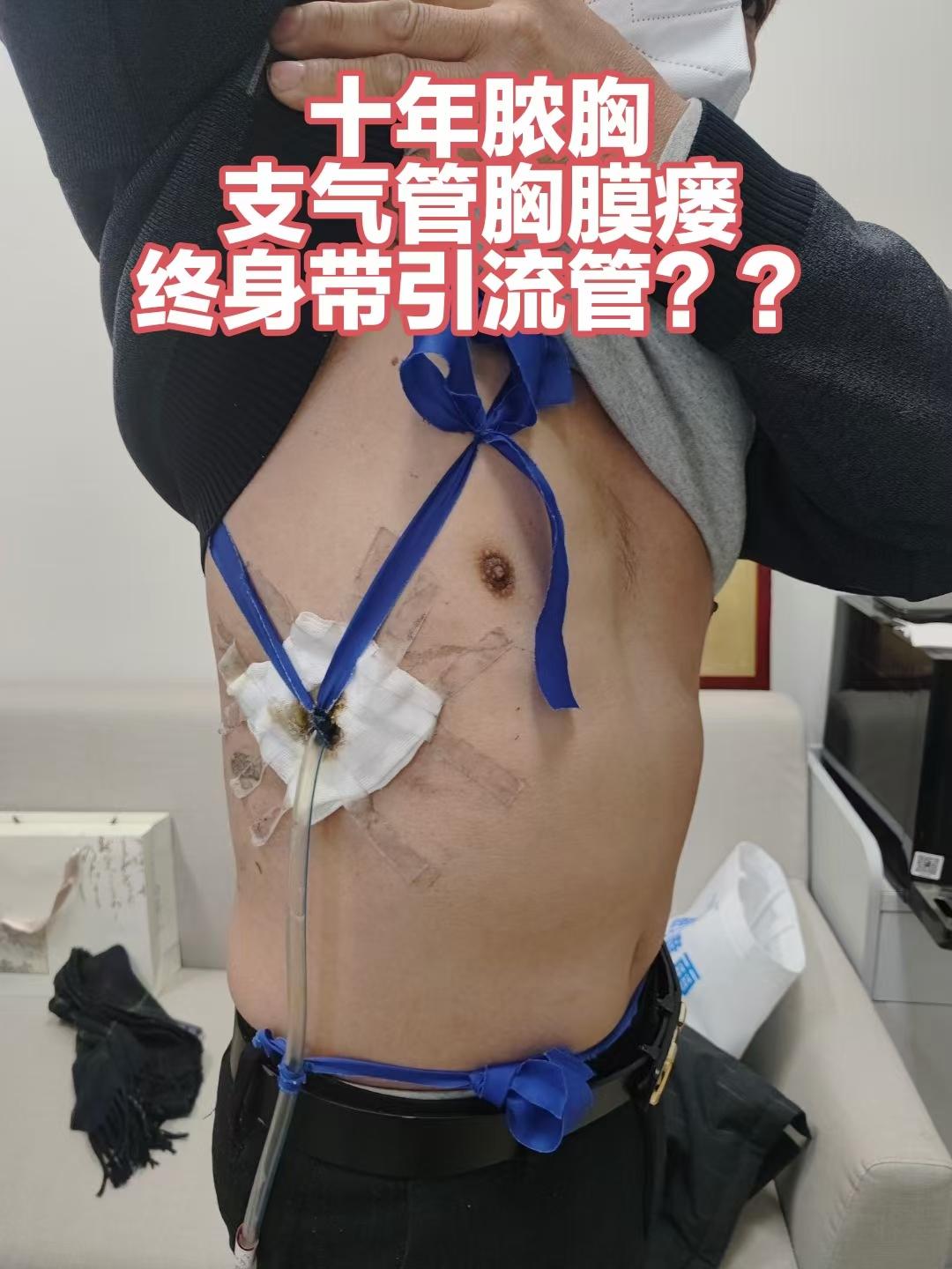 十年脓胸支气管胸膜瘘，终身带管？七院微创修复，术后7天出院，更强效、微...