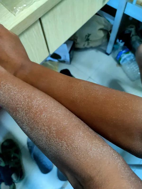 晒黑后为啥迟迟没能白回来？
       普通晒黑只是紫外线刺激黑色素细胞活跃引