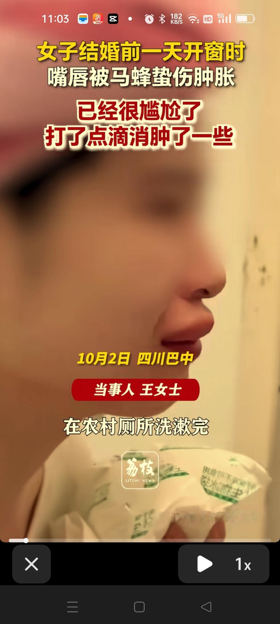 四川的王女士在婚礼前一天嘴被蜜蜂咬了。
被蜜蜂咬了以后，嘴唇马上肿的很高，第二天