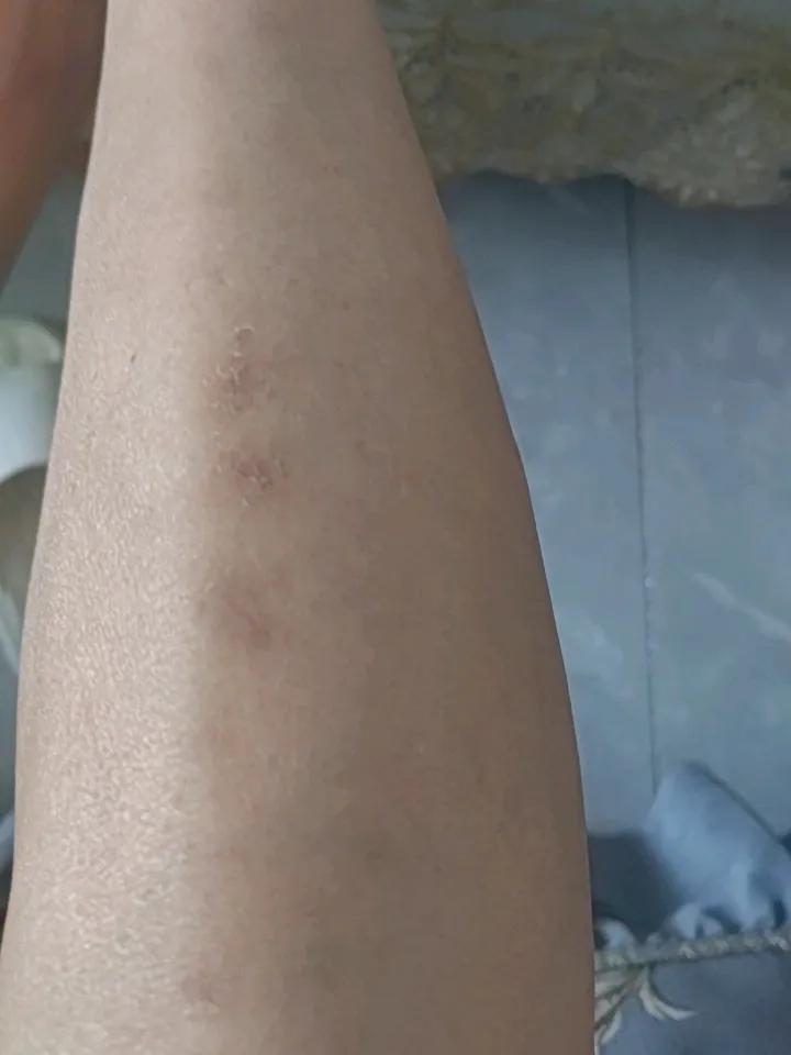 我向蝙蝠侠转变实录
今天是被蝙蝠咬的第三天了，说一下今天身体的感觉：首先发现腿上