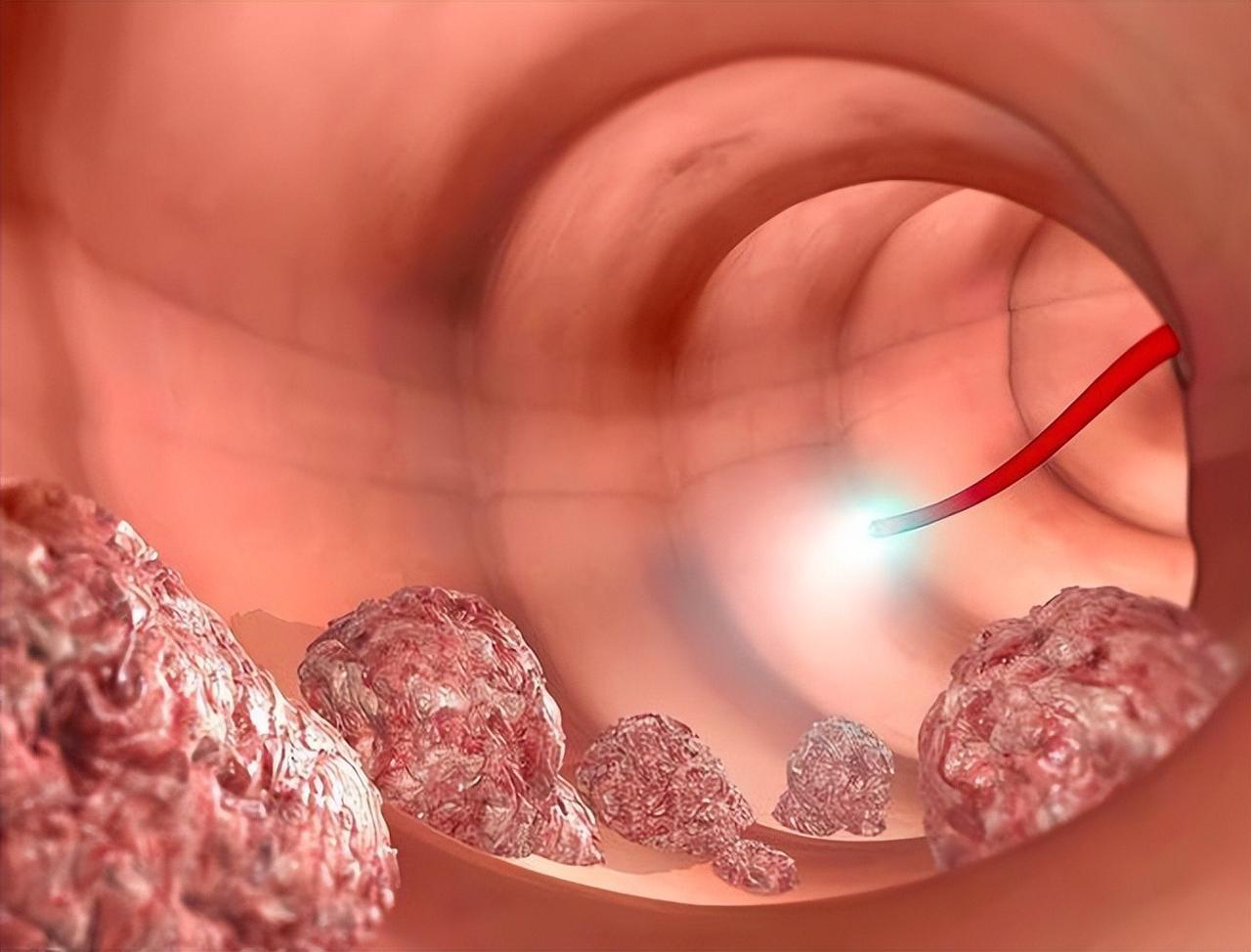 最新研究：黄连素可预防肠息肉；停药6年后，复发风险仍降低42%！

肠息肉不是新