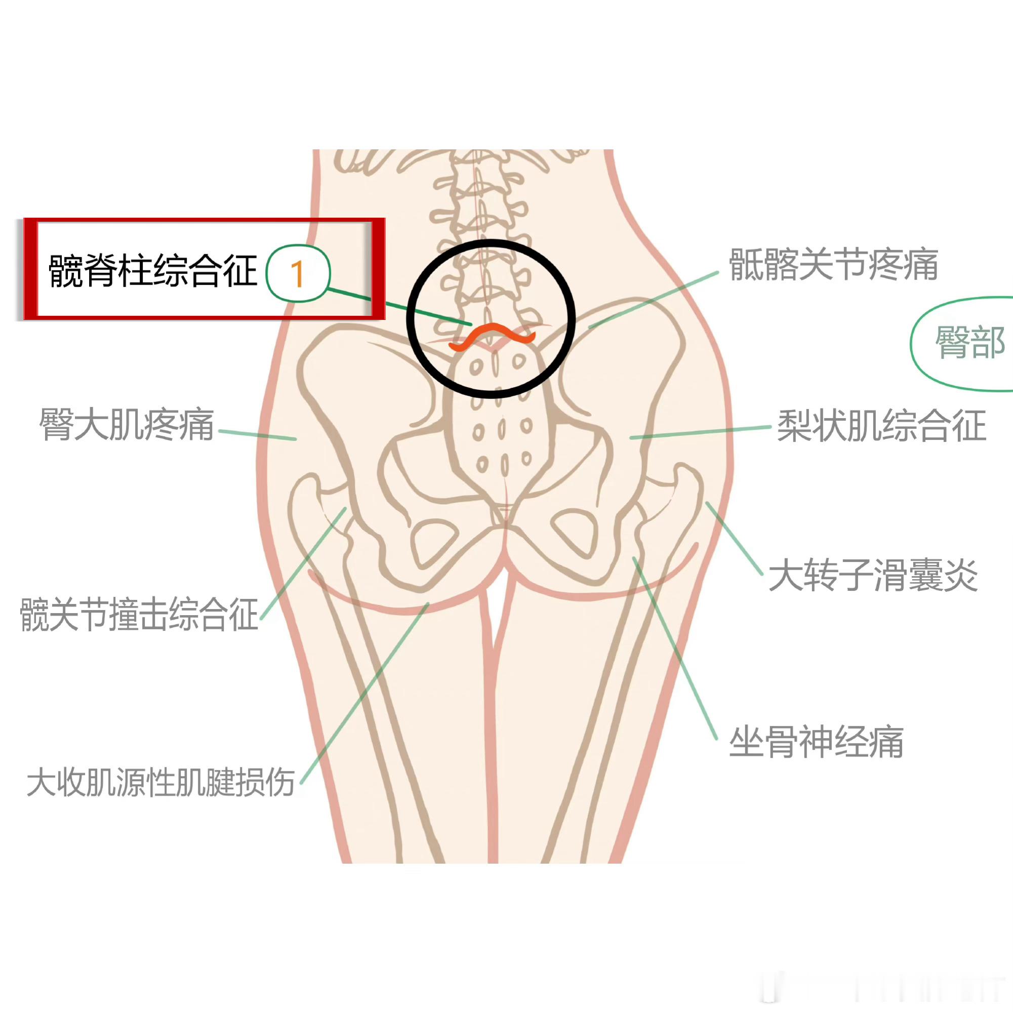 #臀部# 【臀部疼痛自查攻略】腰痛？屁股痛？腿疼？包括还有朋友会腹股沟不适。今天