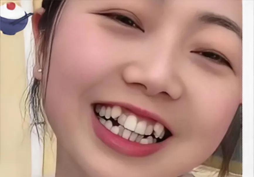 再好的假牙还有自己的真牙好吗?
如果你的真牙没有毛病，没有得各种牙病，既不影响吃